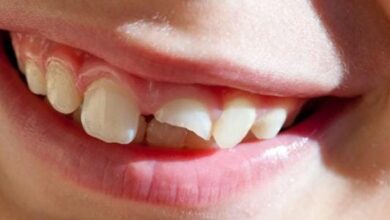 تفسير حلم تكسر الاسنان